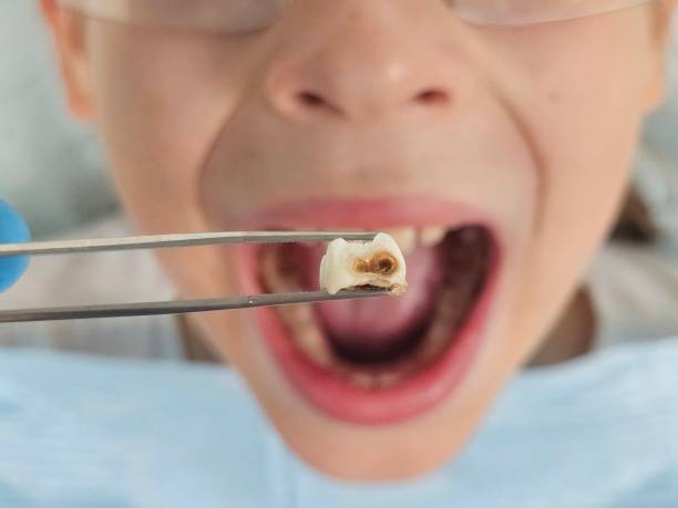 Best Emergency Treatment for Dental Infections or Abscesses in West Columbia, TX